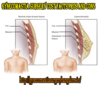 Gynecomastia Surgery Image